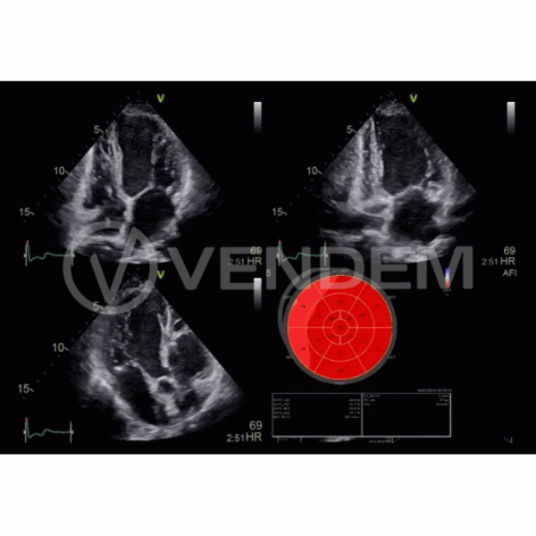 Аппарат УЗИ (сканер) GE Healthcare Vivid E90