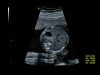 Аппарат УЗИ (сканер) GE Healthcare Voluson S10