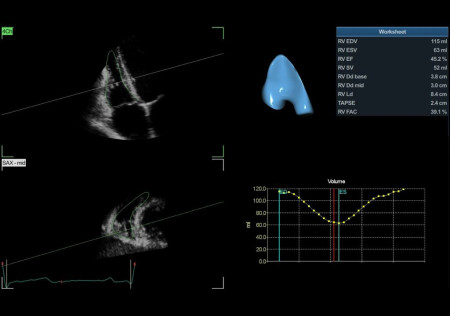 Аппарат УЗИ (сканер) GE Healthcare Vivid E95