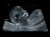 Аппарат УЗИ (сканер) GE Healthcare Voluson S10