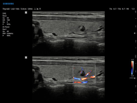 Аппарат УЗИ (сканер) Samsung Medison V8