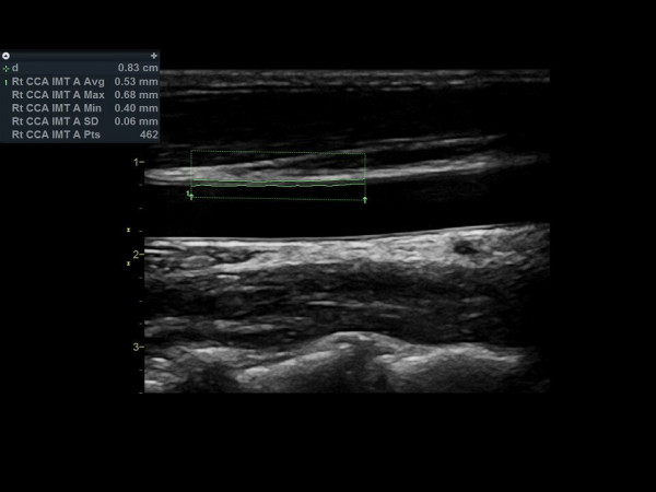 Аппарат УЗИ (сканер) GE Healthcare Vivid S60N