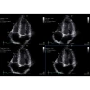 Аппарат УЗИ (сканер) GE Healthcare Vivid E90
