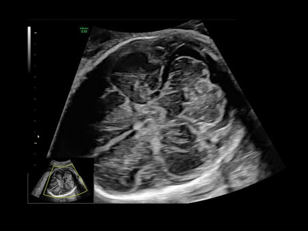 Аппарат УЗИ (сканер) GE Healthcare Voluson E10 RSA