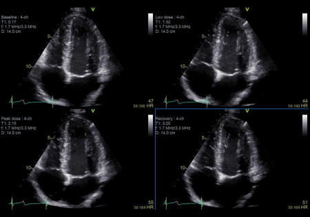 Аппарат УЗИ (сканер) GE Healthcare Vivid S70N