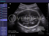 Аппарат УЗИ (сканер) Siemens Healthineers Acuson X300 PE