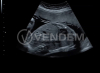 Аппарат УЗИ (сканер) GE Healthcare Voluson S8