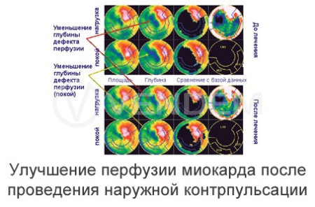 Аппарат усиленной наружной контрпульсации Chongqing PSK-Health P-ECP/TI (КНР)