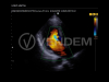 Аппарат УЗИ (сканер) Samsung Medison HM70