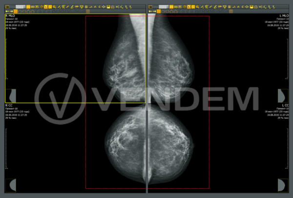 АРМ врача МТЛ Диарм-МТ для просмотра маммографических изображений